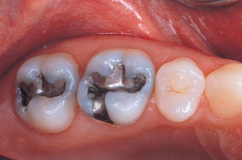 amalgam-dolgu-e1487927112810.jpg